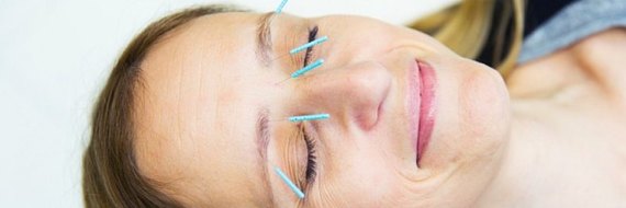 J’ai testé l’acupuncture pour lutter contre les rides