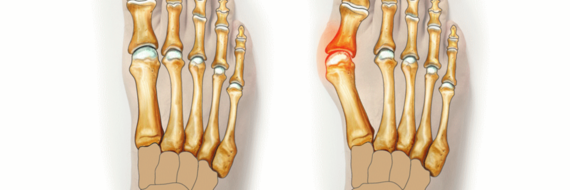 Tout savoir sur l’hallux valgus et son traitement