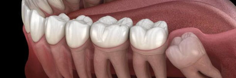 Extraction de dent de sagesse : tout ce qu’il faut savoir pour bien se préparer