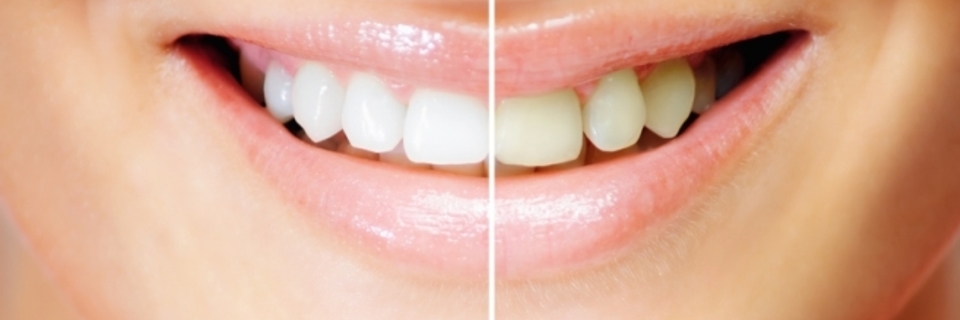Des dents blanches à tout prix ?