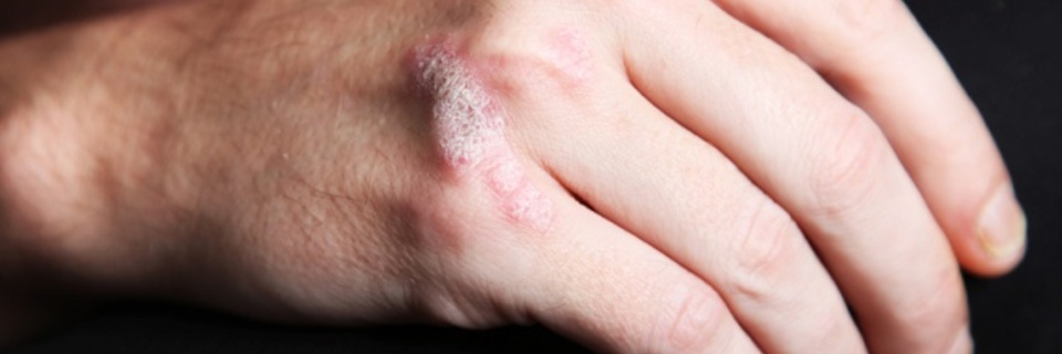 Le psoriasis en questions
